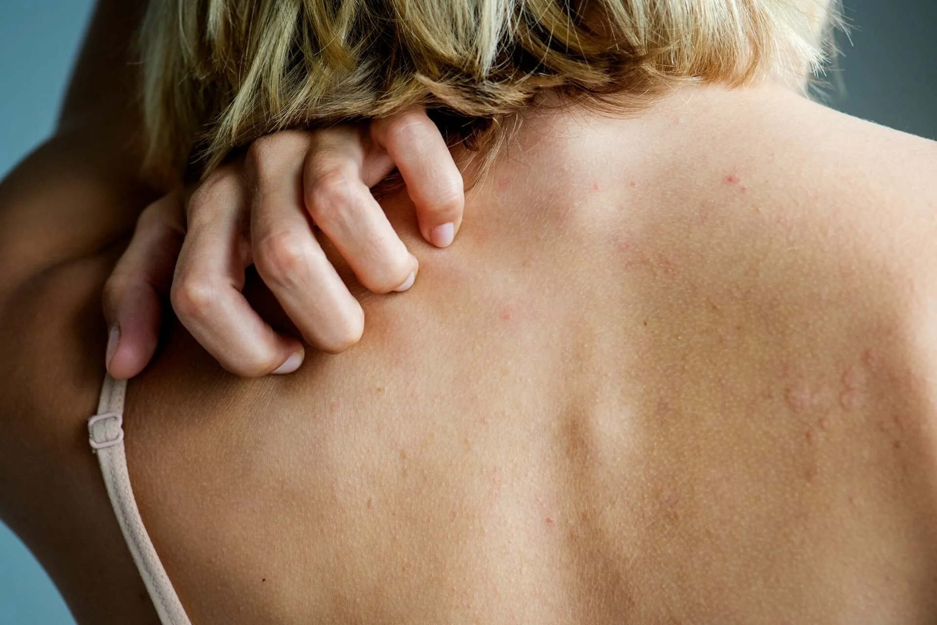 Are You Struggling with Psoriasis: Use This Guide to Alleviate Symptoms